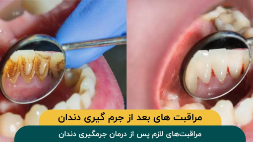 مراقبت-های-لازم-پس-از-درمان-جرمگیری-دندان